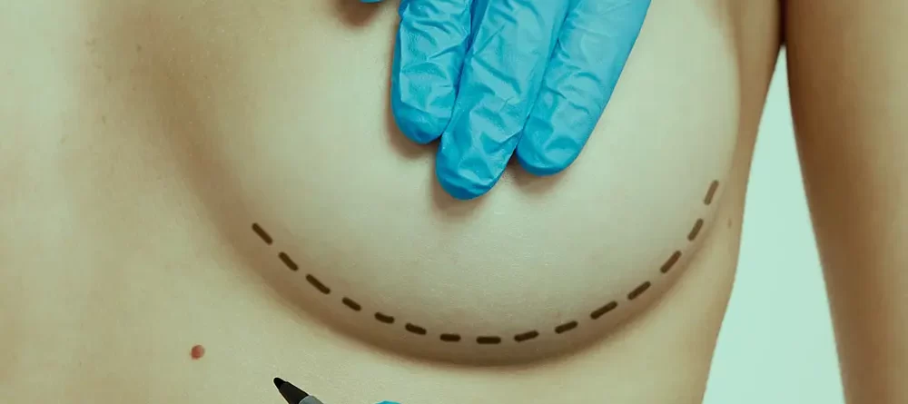 o que é a mamoplastia de aumento