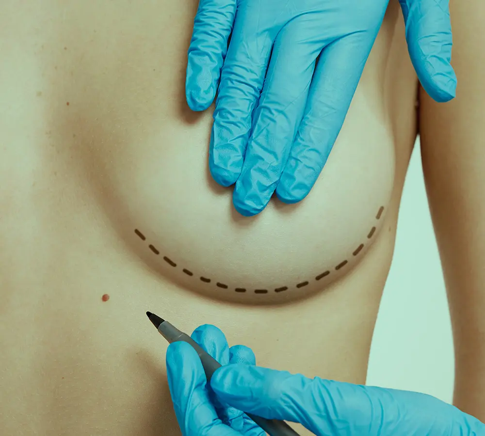 o que é a mamoplastia de aumento