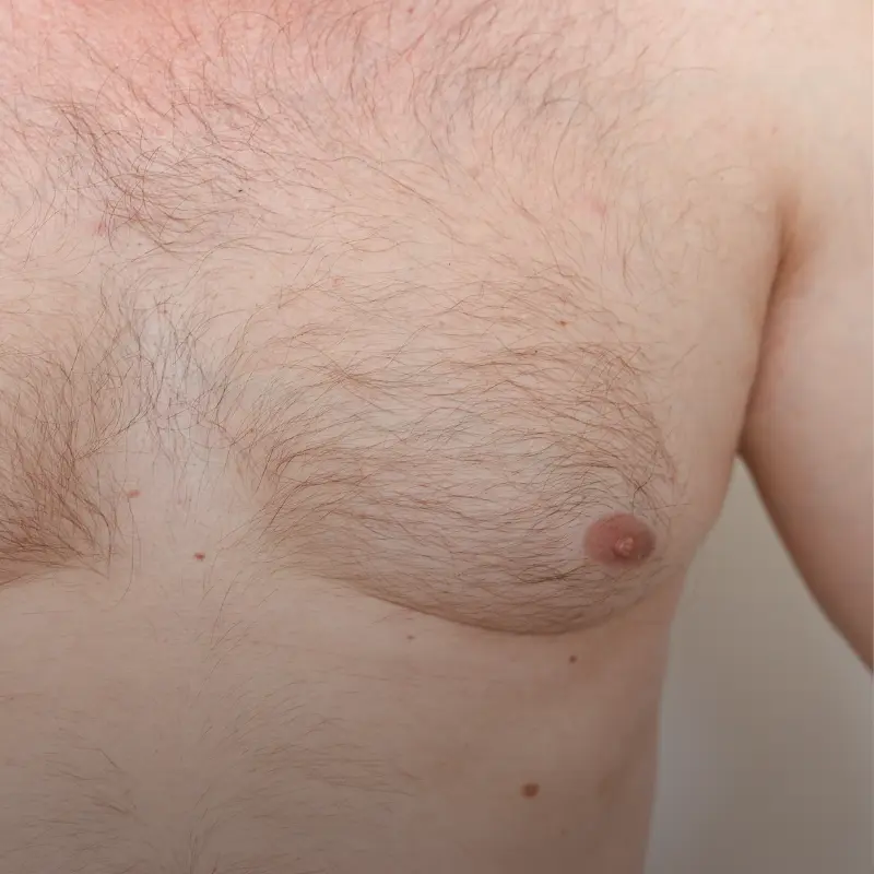 Ginecomastia: Saiba como a Dra. Isabel Bartosch pode ajudar