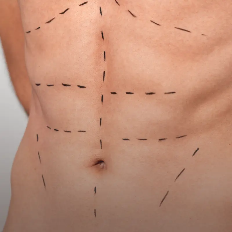 lipoescultura HD Masculina