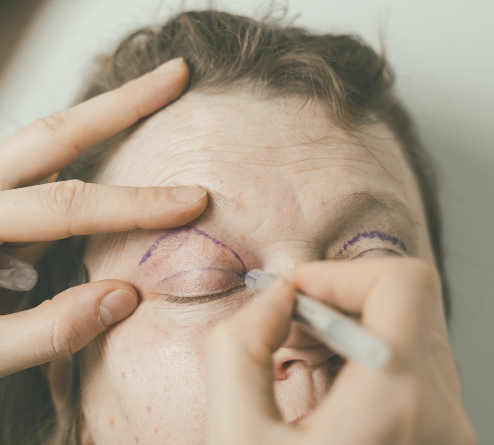 blefaroplastia cirurgia