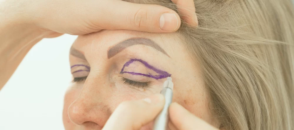 blefaroplastia
