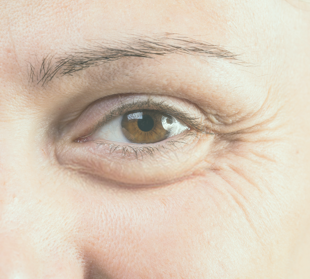 blefaroplastia