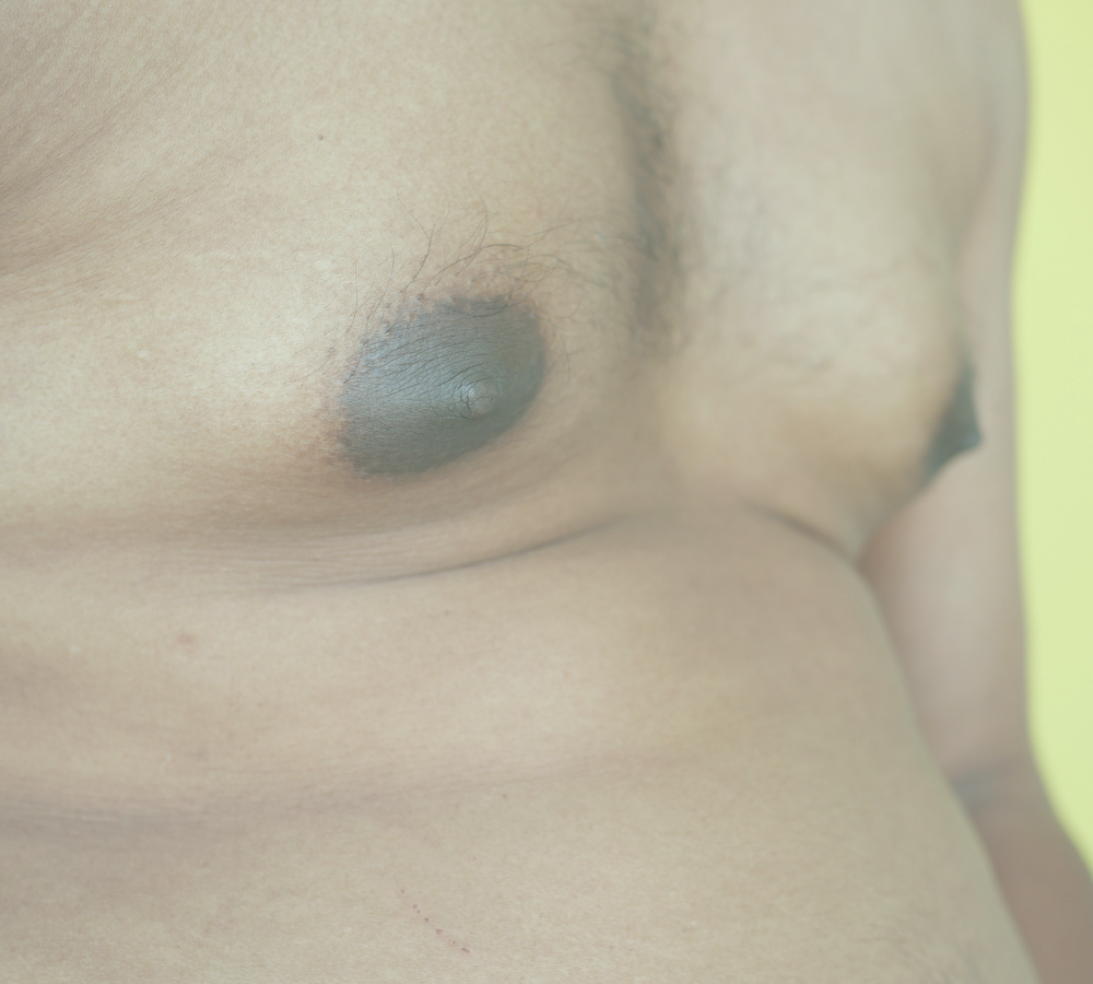 ginecomastia-cirurgia